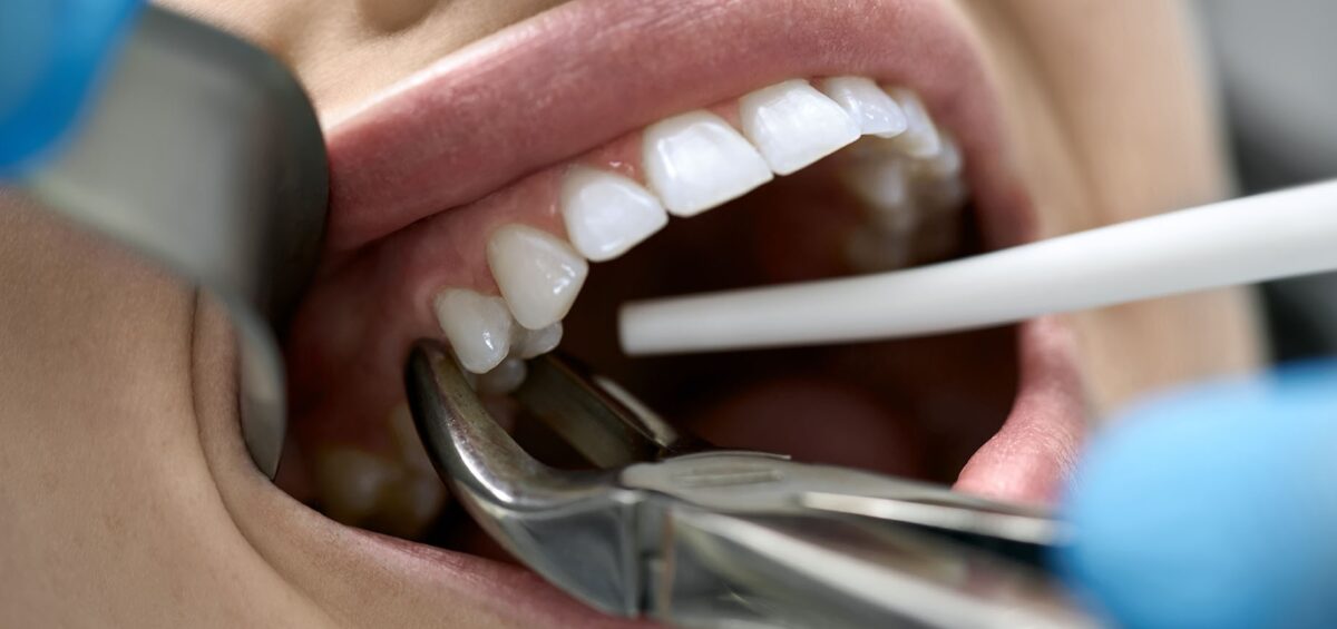 How Long for Tooth Extraction to Heal - North York Dental Clinic